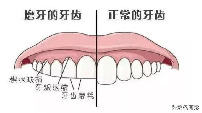 夜磨牙现象，最新研究与防治策略解析