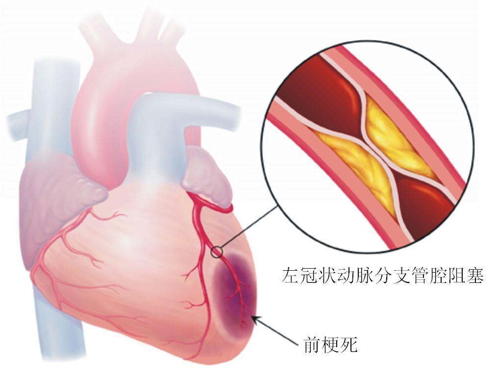 心肌梗死最新诊断标准概述