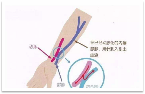 静脉瘘最新研究与应用进展